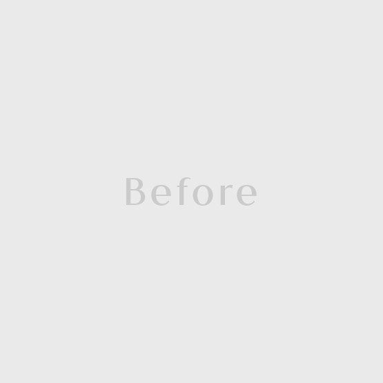 Before Nose Threadlift Cuping